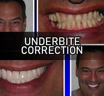 Killer Underbite on Tumblr: How to Clean Your Teeth When Your Jaw