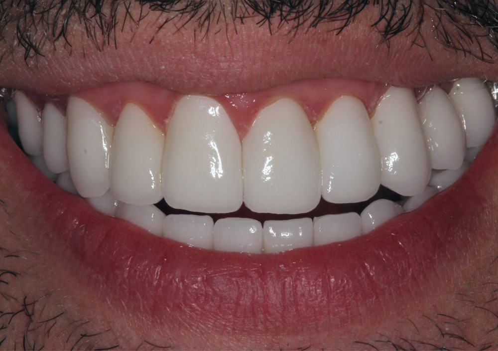 Underbite Correction After