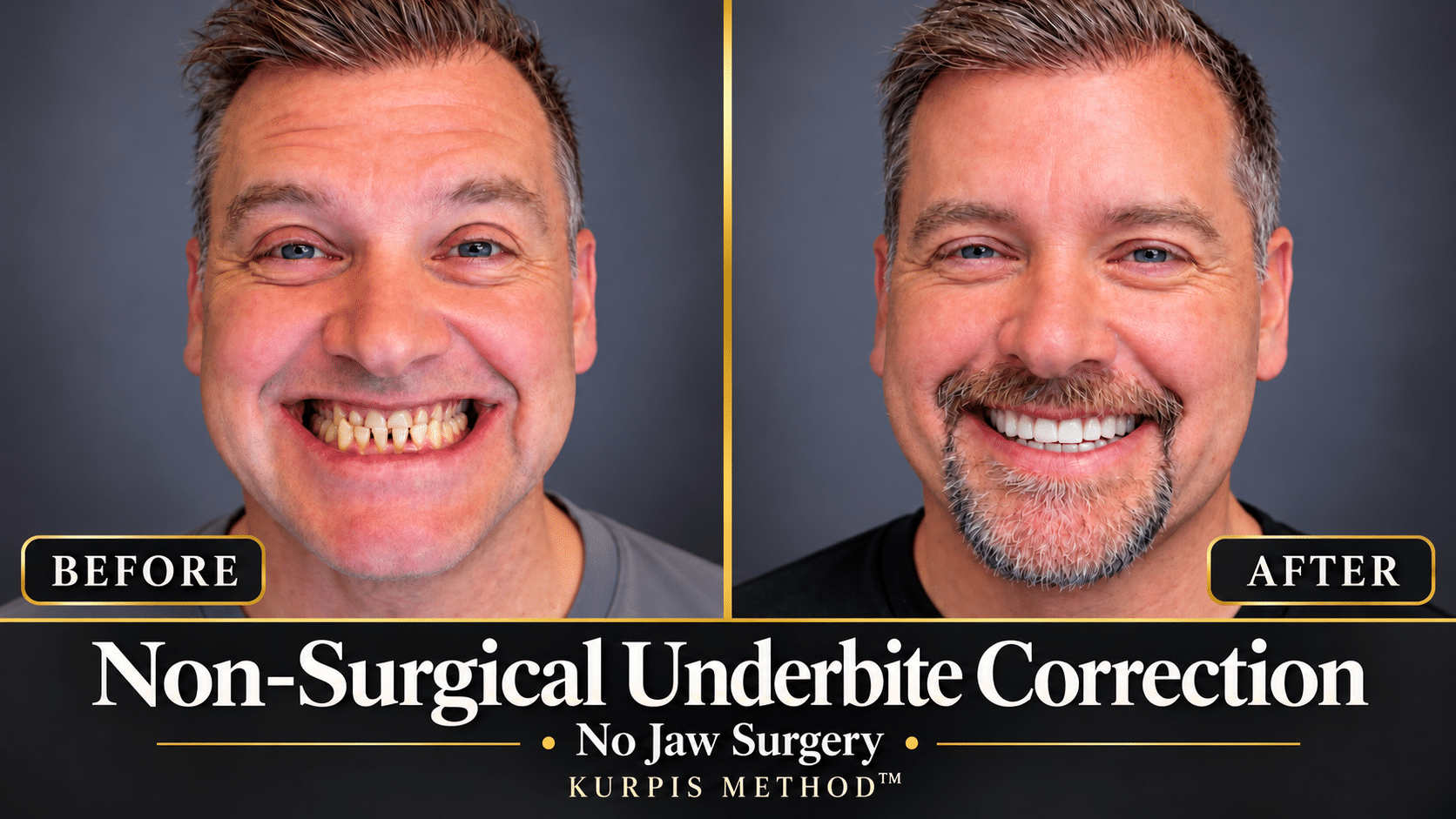 Non-Surgical Underbite Correction | No Jaw Surgery | Kurpis Method™